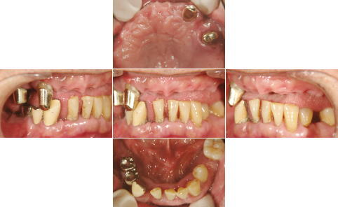 All-on-4�O�̑g�摜