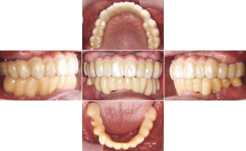 All-on-4 �r�t�H�[�A�t�^�[�ʐ^