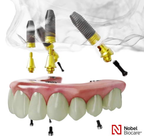 �I�[���I��4�@�C���v�����g�@����