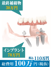 all-on-4 ���z100���~�@���l�ł��ȃC���v�����g