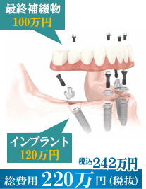 all-on-4 ���z200���~�@���x�̍����C���v�����g