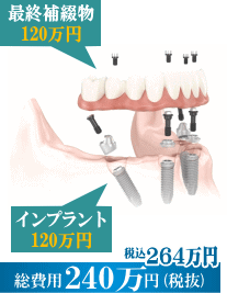 all-on-4 ���z240���~�@�ō��i���̃C���v�����g